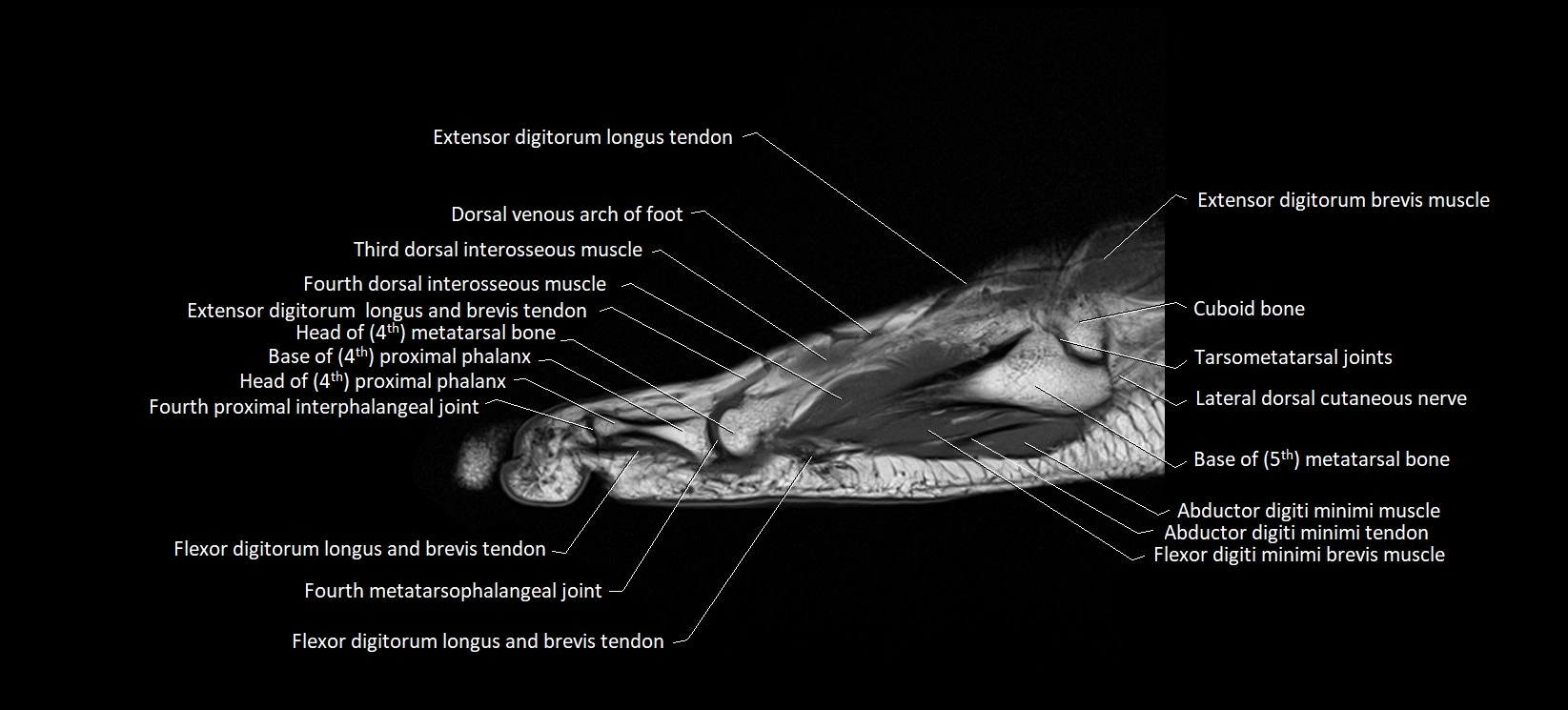 MRI foot sagittal labelled cross sectional anatomy image  20.webp
